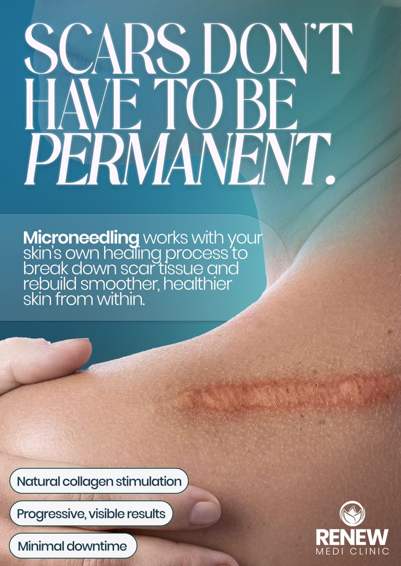 Microneedling for scars poster