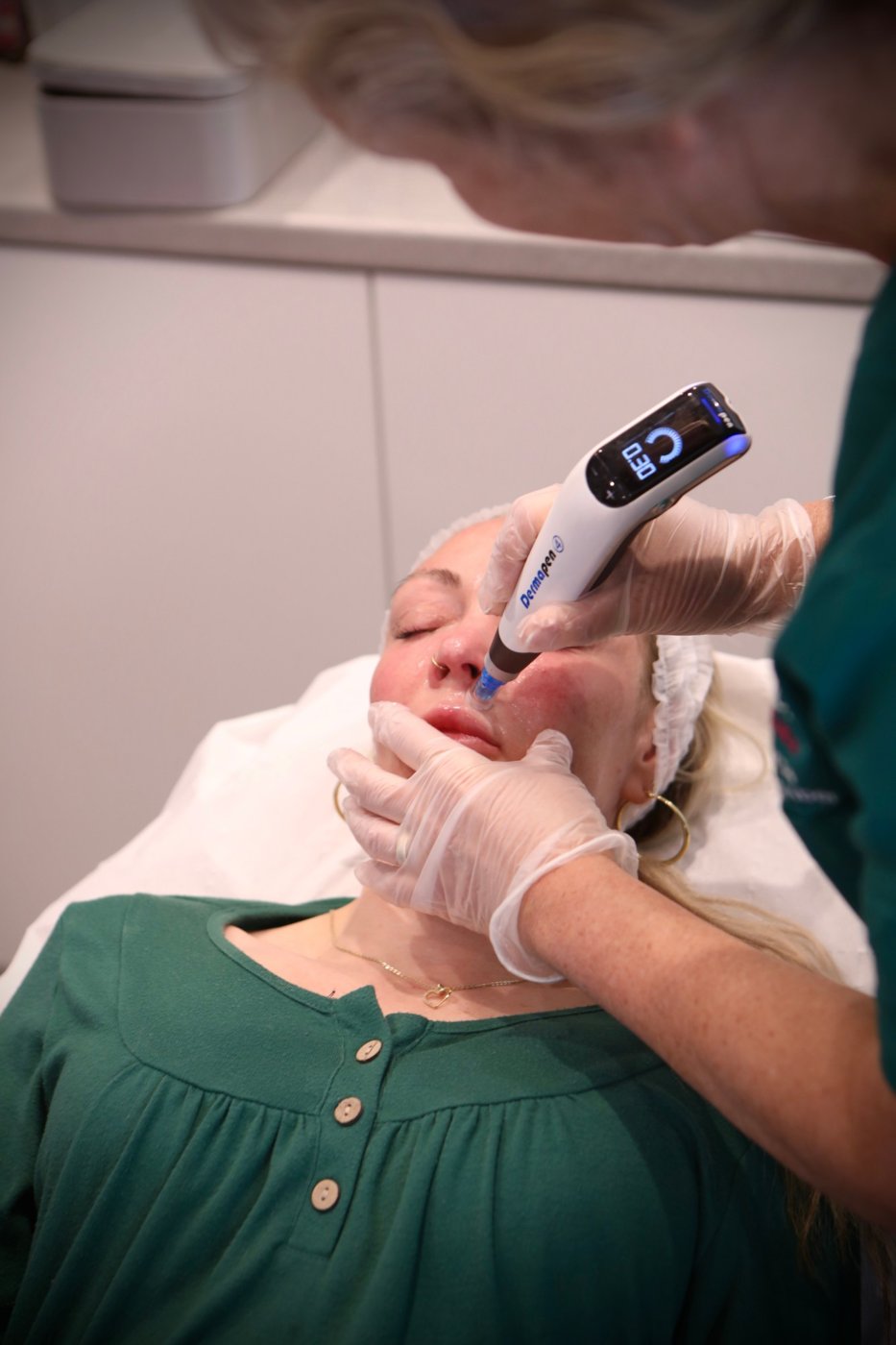 Microneedling treatment with a Dermapen